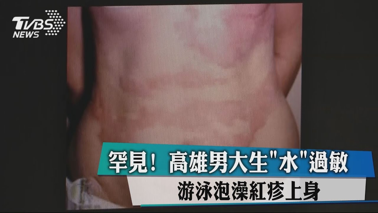 罕見！高雄男大生「水」過敏　游泳泡澡紅疹上身