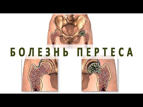 Остеоартроз коленного сустава народное лечения Болит переход от шеи к плечу