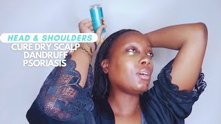 How To Cure Dry Scalp, Dandruff and Psoriasis using Head & Shoulders Scalp Treatment | DYDY xoxo