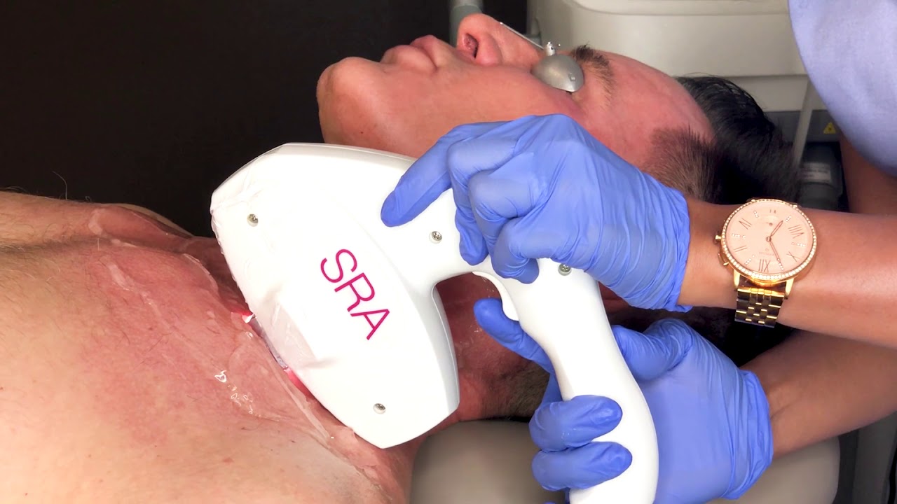 Poikiloderma Treatment With Intense Pulsed Light (IPL) - YouTube