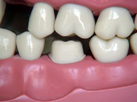 Full metal crown preparation - for dental students