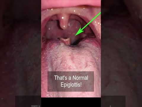 ENT strange factoids. The “It is abnormal!” But is actually normal epiglottis #shorts @fauquierent