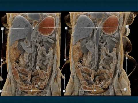 CT Evaluation of Small Bowel Obstruction: Pearls and Pitfalls in Clinical Practice - Part 5