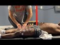 Bodybuilder Massage Therapy Cupping, Soft Tissue mobilization No More Tight Hips