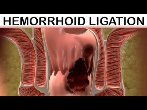 Rubber Band Hemorrhoid Ligation: Trinsic Medical Animation