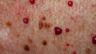 Cherry Hemangioma Signs, Causes, Diagnosis, Treatment