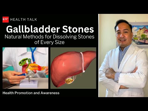 Bato sa apdo: May pagasa pa bang malusaw sa natural na paraan? Gallbladder stones