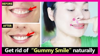 Just 4 steps! How to get rid of Gummy Smile naturally. No braces or Surgery | Gummy smile exercises.