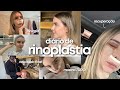 FIZ RINOPLASTIA MOSTREI TUDO Recuperação Pós Antes E Depois Diário De Cirurgia Completo