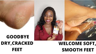 How to Get Rid of Dry, Cracked Feet Fast Using Apple Cider Vinegar(ACV), Easy DIY Pedicure at home