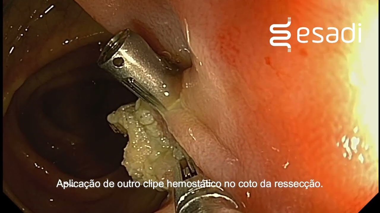 Polipectomia de pólipo pediculado de grande tamanho - clínica Esadi - Dr. Pedro E. S. Silva