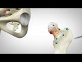 Knie- of heupoperatie? Dokter robot helpt!