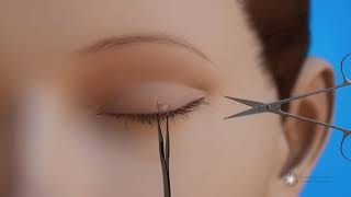 Surgery to Remove Lesions from the Eyelid