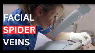 How to GET RID of Thread Veins and Spider Veins on Your Nose & Cheeks (Telangiectasia Treatment)