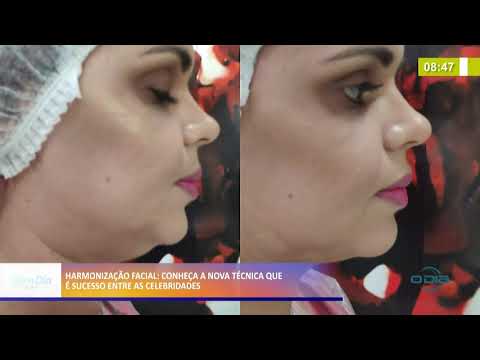 Tratamento de harmonizacão facial eÌ cada vez mais procurado 28 09 2020