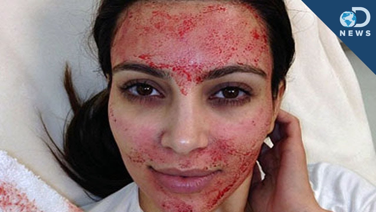 Kim Kardashian's Blood Facial Explained