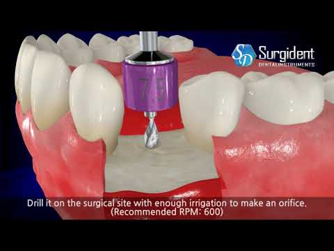 Implant Positioning Kit- IPO Kit