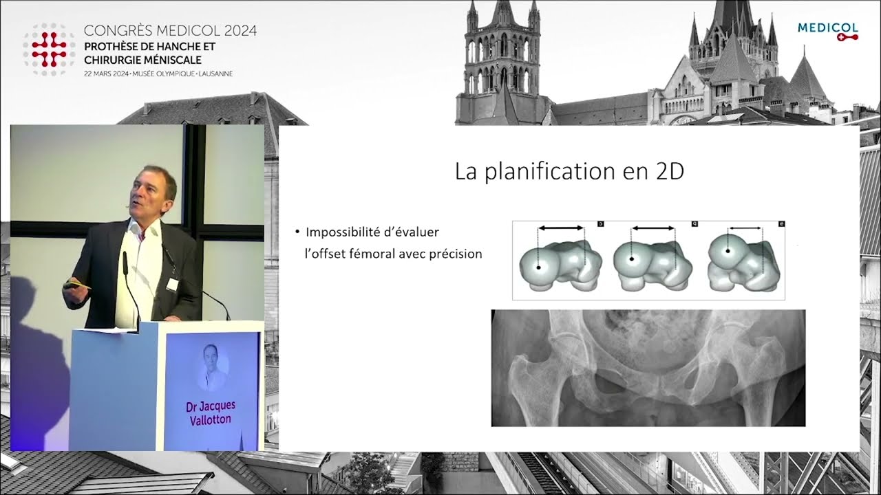 Planification 3D en pratique et perspectives - Dr Jacques Vallotton