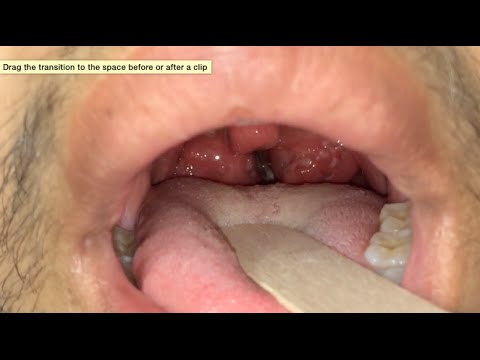 Mga larawan ng mga halamang-singaw sa mga kamay kuko Epektibong paraan ng interdigital toe fungus
