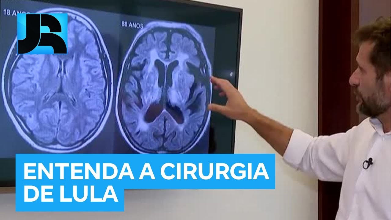 Entenda o sangramento que ocasionou a cirurgia de emergência de Lula nesta terça (10)