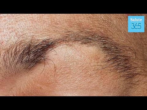 Eczema di Lise Burbo su mani Che togliere un prurito a dermatite atopic