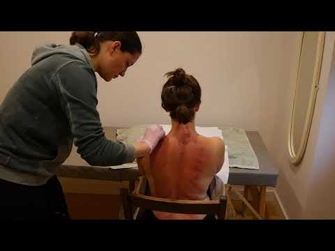 Jacina Acupuncture video.