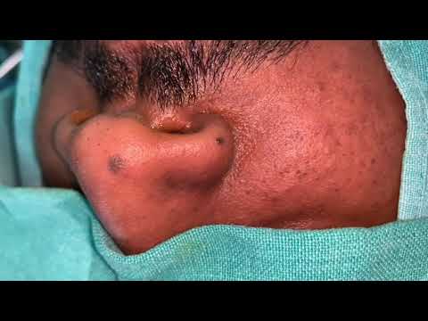 Scar Less Mole Removal