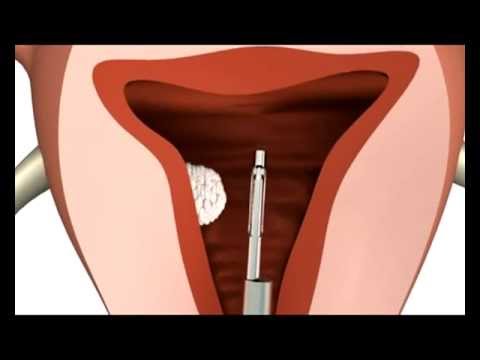 Hysteroscopic Myomectomy || Medicana Konya Tüp Bebek Merkezi̇