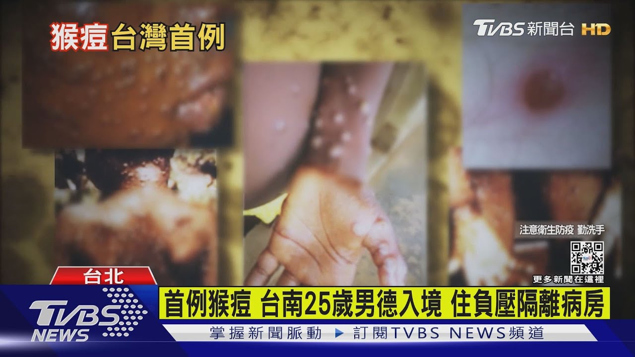 有片/首例猴痘!台南25歲男德入境住負壓隔離病房