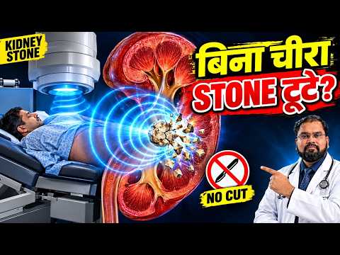 ESWL Kidney Stone Treatment | बिना चीरे पथरी कैसे टूटती है?