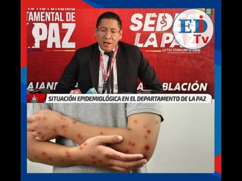 La Paz confirma dos nuevos casos de sarampión en Ixiamas
