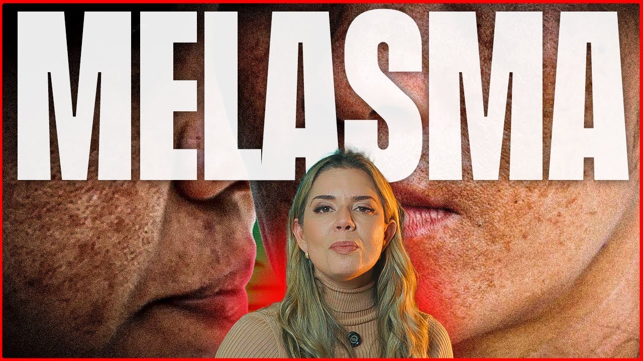 COMO ACABAR COM O MELASMA !