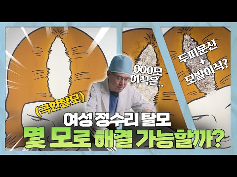 여성 정수리 모발이식, 딱 이 정도로 채울 수 있습니다