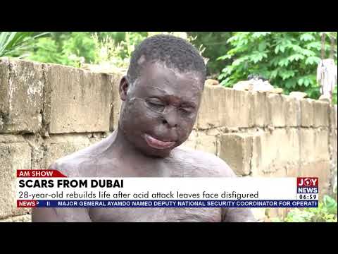 Scars From Dubai: 28-year-old fights to rebuild life after acid attack leaves his face disfigured