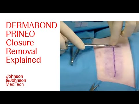 How to Safely Remove DERMABOND PRINEO Skin Closure System | J&J MedTech