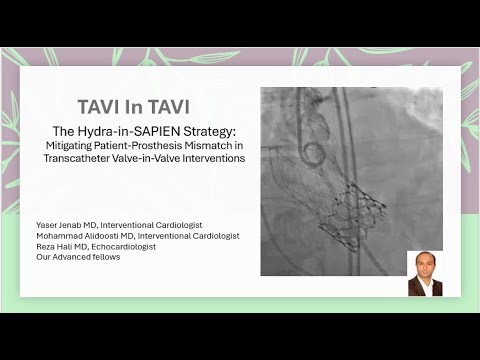 TAVI in TAVI with Hydra valve