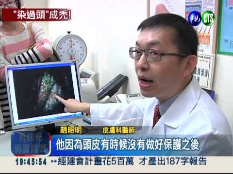 染髮過度傷頭皮 28歲女子禿頭
