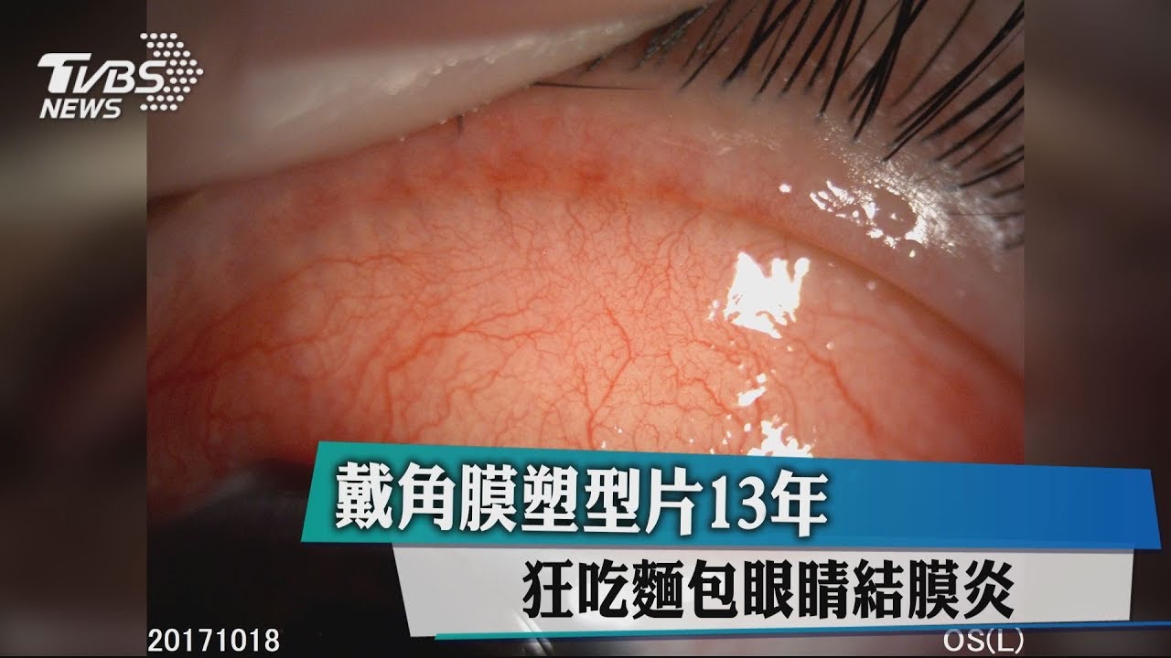 戴角膜塑型片13年 狂吃麵包眼睛結膜炎