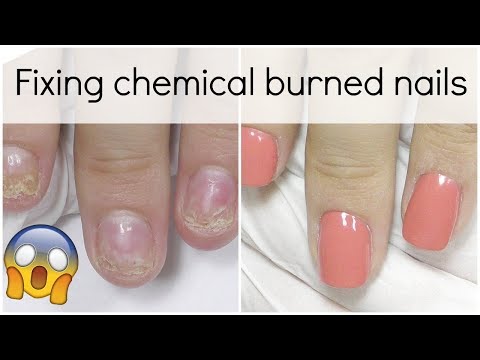 Extremely damaged nail transformation - How to fix it with Polygel