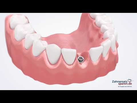 Behandlungsablauf: Verschraubte Krone auf Implantat - Zahnersatzsparen.de