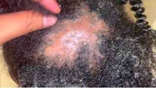 UPDATE: 1 WEEK: Scalp Fungal Infection