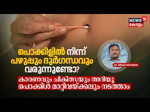 Dr. Q | പൊക്കിളിൽ നിന്ന് പഴുപ്പും ദുർഗന്ധവും വരുന്നുണ്ടോ? Cause-Treatment| Transplantഉം നടത്താം|N18V