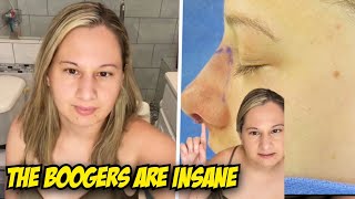 Gypsy Rose Blanchard Gives 'TMI' Update On Her Nose Job Recovery