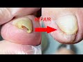 Repair toenail that curl inward and become embedded in the flesh | Satisfying video