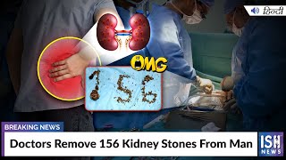 Doctors Remove 156 Kidney Stones From Man