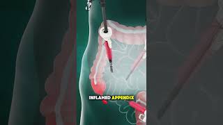 “Appendectomy Surgery Procedure | Must Watch 👩‍⚕️🔪” #healthawareness #science
