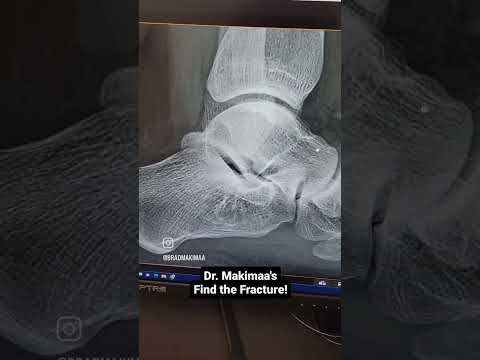 Find the fracture - posterior lateral process of the talus fracture