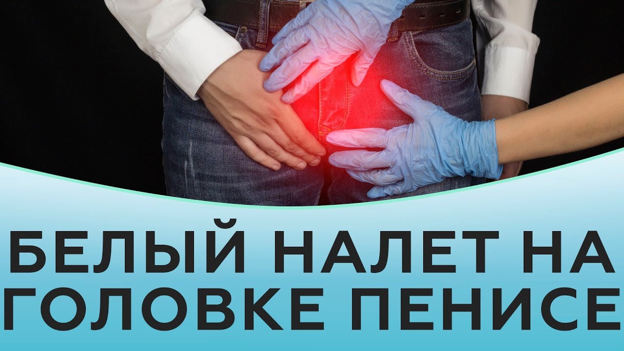 Белый налет на головке полового члена у мужчин