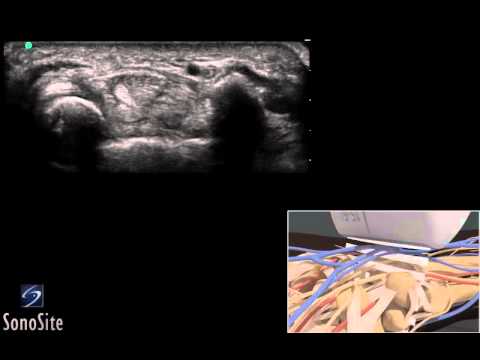 Trattamento delle ernie della colonna vertebrale sanguisughe recensioni Dente malato collo gonfio