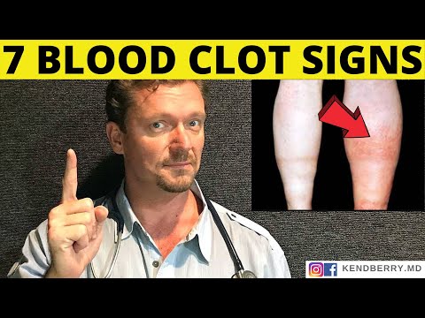 7 Warning Signs of a BLOOD CLOT (Symptoms) 2024